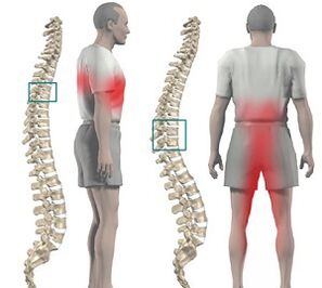 durere la nivelul coloanei vertebrale cu osteocondroză toracică