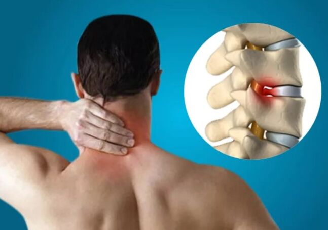 Osteochondroza cervicală