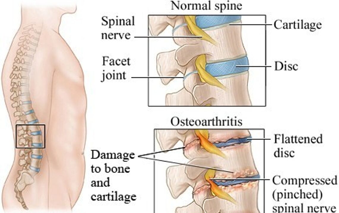Diferența dintre un disc sănătos și un disc cu osteochondroză