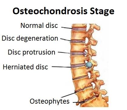 Etapele osteochondrozei