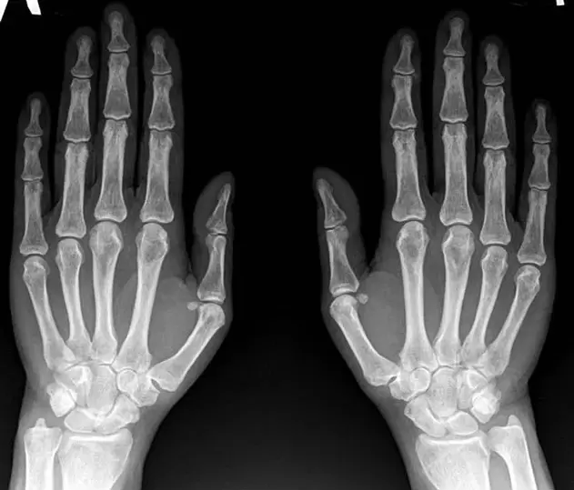 artrita articulației încheieturii mâinii la radiografie înainte de a utiliza Hondroine